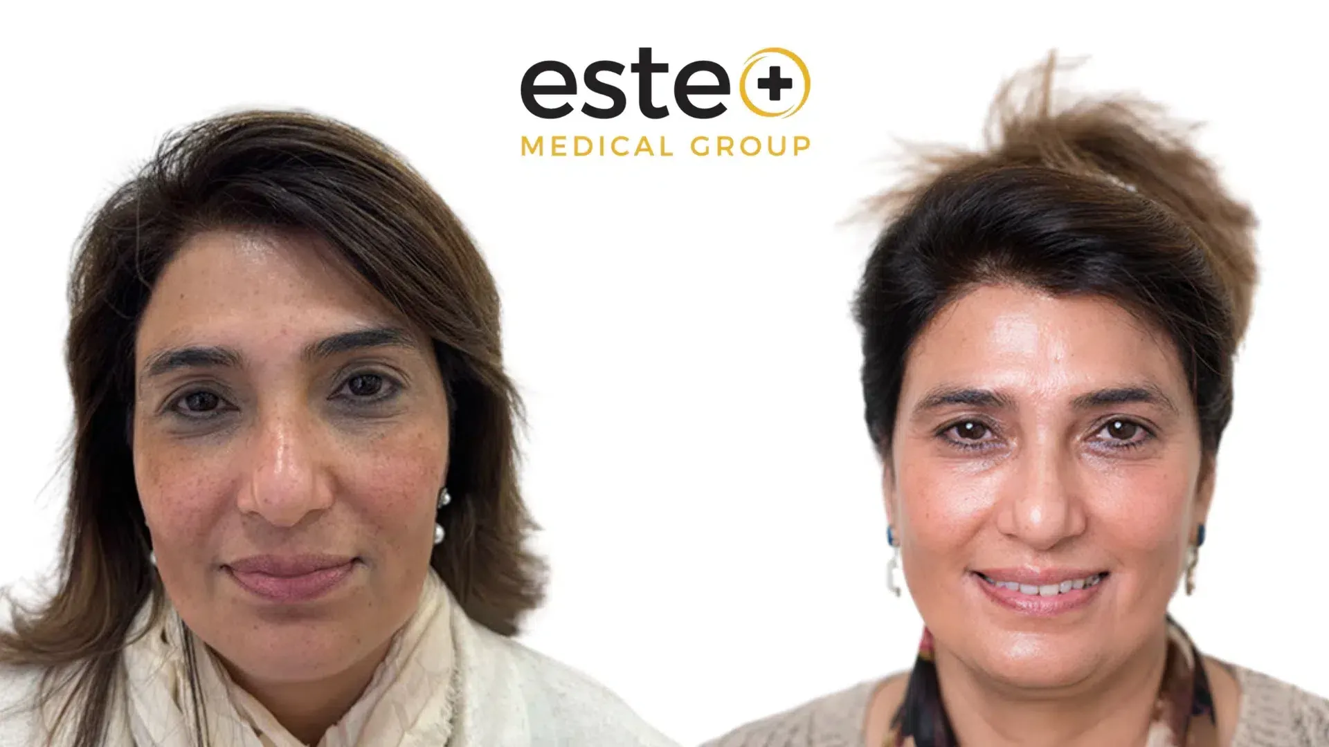 Skin pigmentation before and after results (Cosmelan)