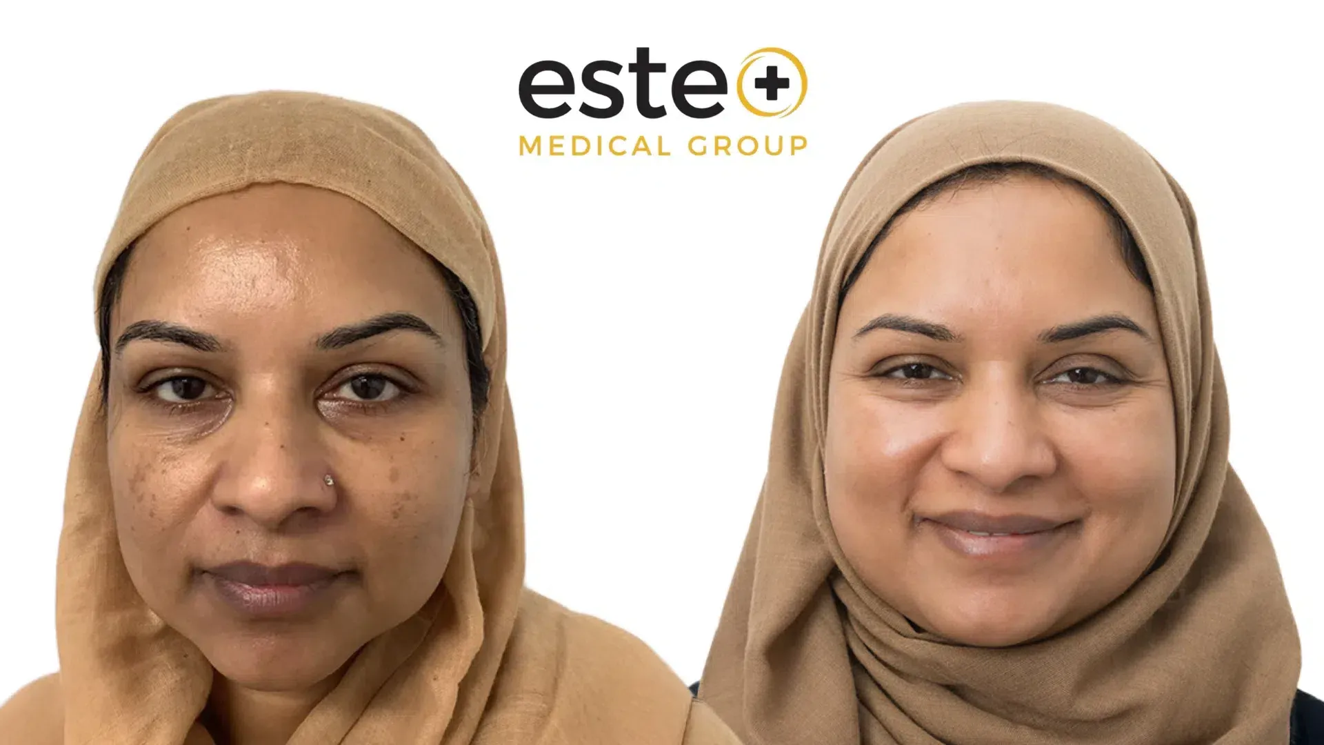 Cosmelan pigmentation before and after results