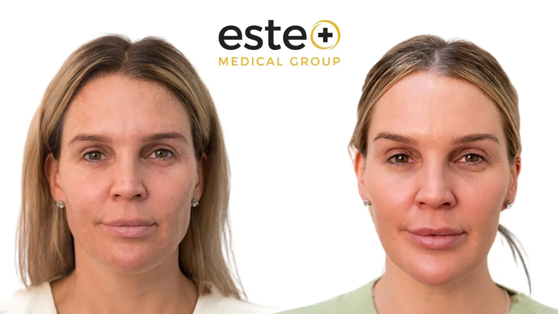 Skin pigmentation reduction before and after (Cosmelan)